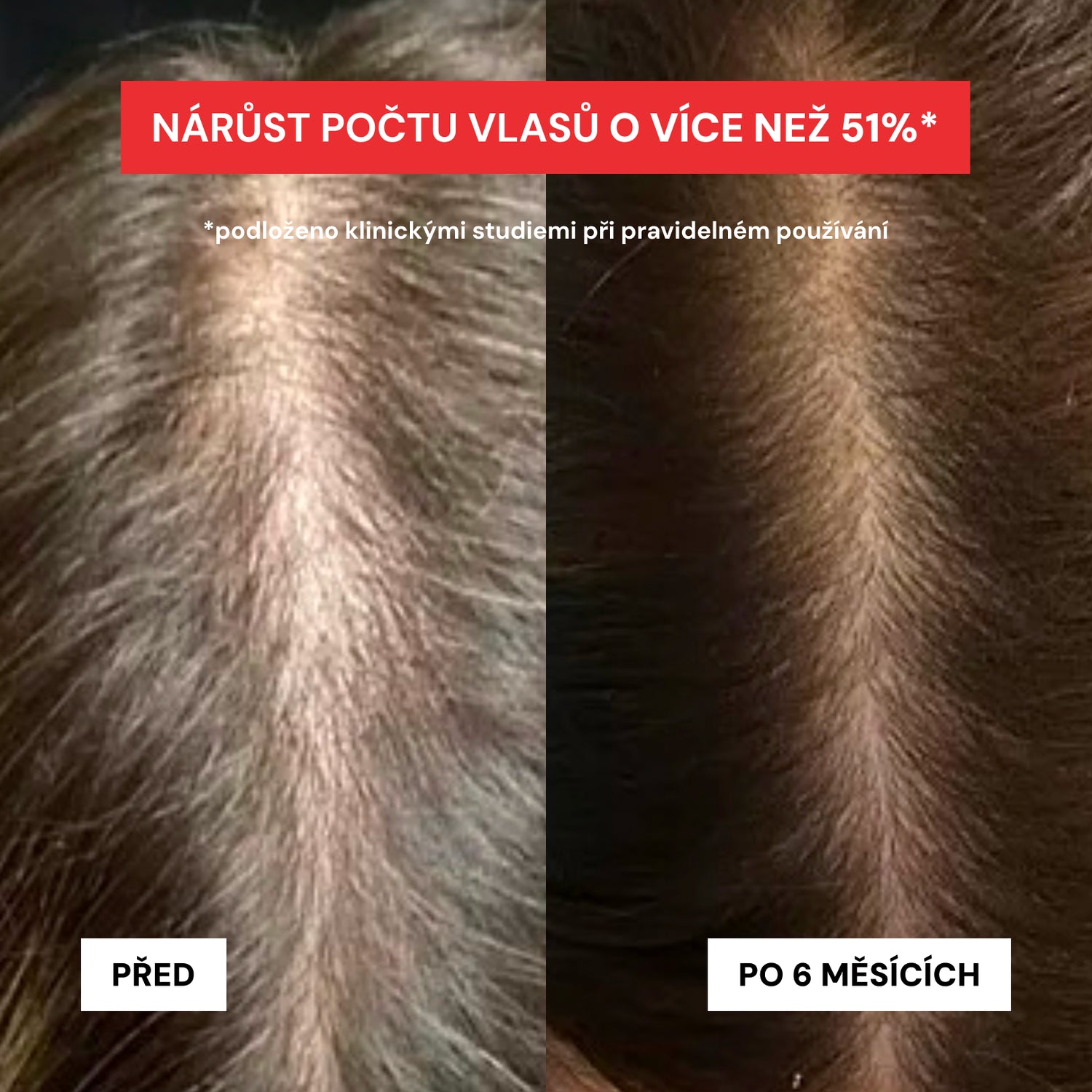 BOOSTETIX PRIME – Laserová čepice pro podporu růstu vlasů